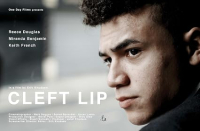 Cleft Lip 2018